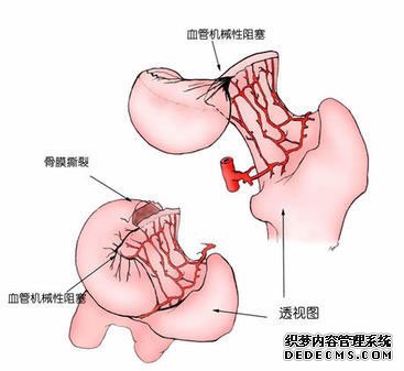 你需要知道的前列腺增生的四大类型